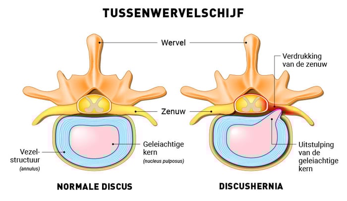 Afbeelding van een discushernia